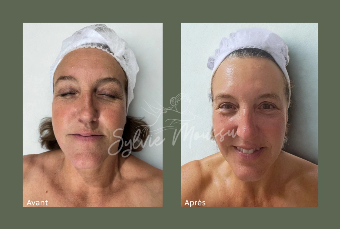 Résultats Hydradermie 1000 avant/après
